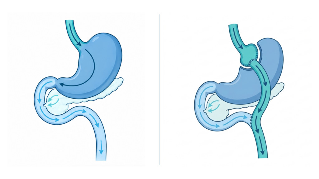 gastric-bypass-before-after.webp