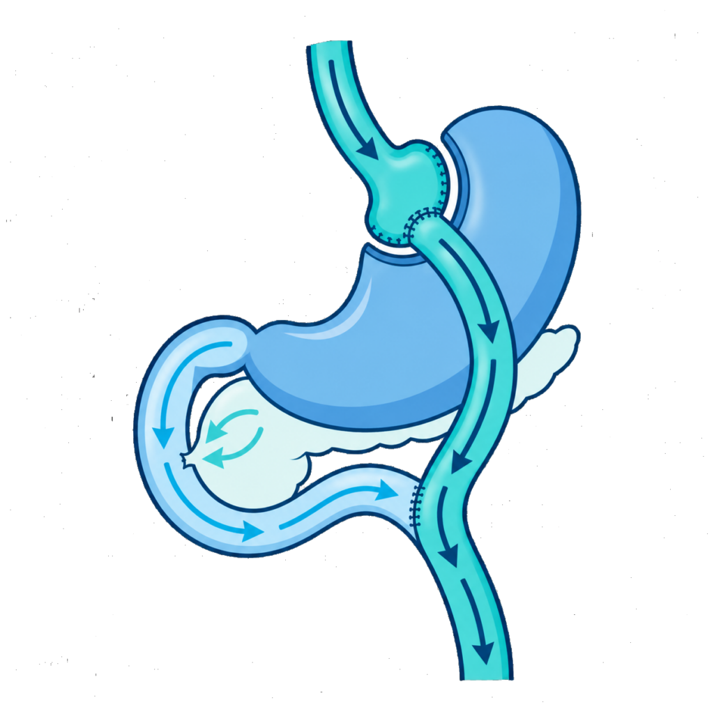 Schéma anatomique du circuit digestif après un bypass gastrique en Y de Roux